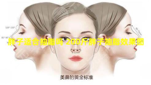 胖子适合抽脂吗 200斤胖子抽脂效果图